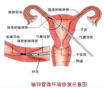 通草的功效与作用能通输卵管堵塞,实际案例解析说明_1080p22.715